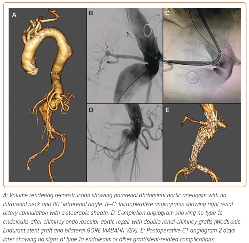 Endovascular Management of Juxtarenal and Pararenal Abdominal Aortic Aneurysms: Role of Chimney Technique