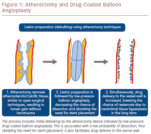 The Role of Atherectomy in Peripheral Artery Disease: Current Evidence and Future Perspectives