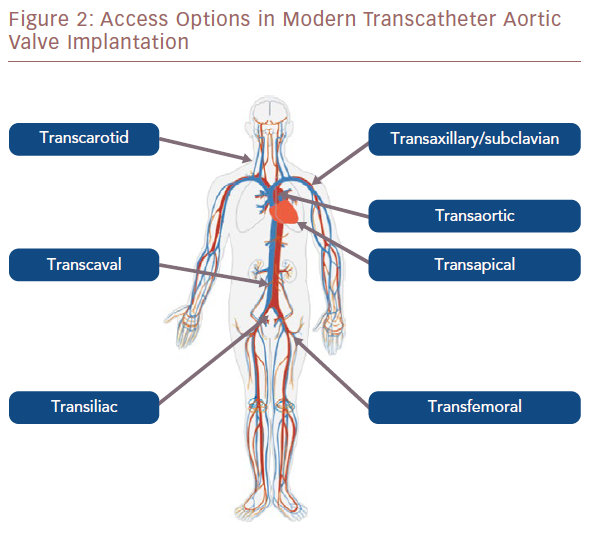 Alternative Access for Transcatheter Aortic Valve Implantation: Current Evidence and Future Directions
