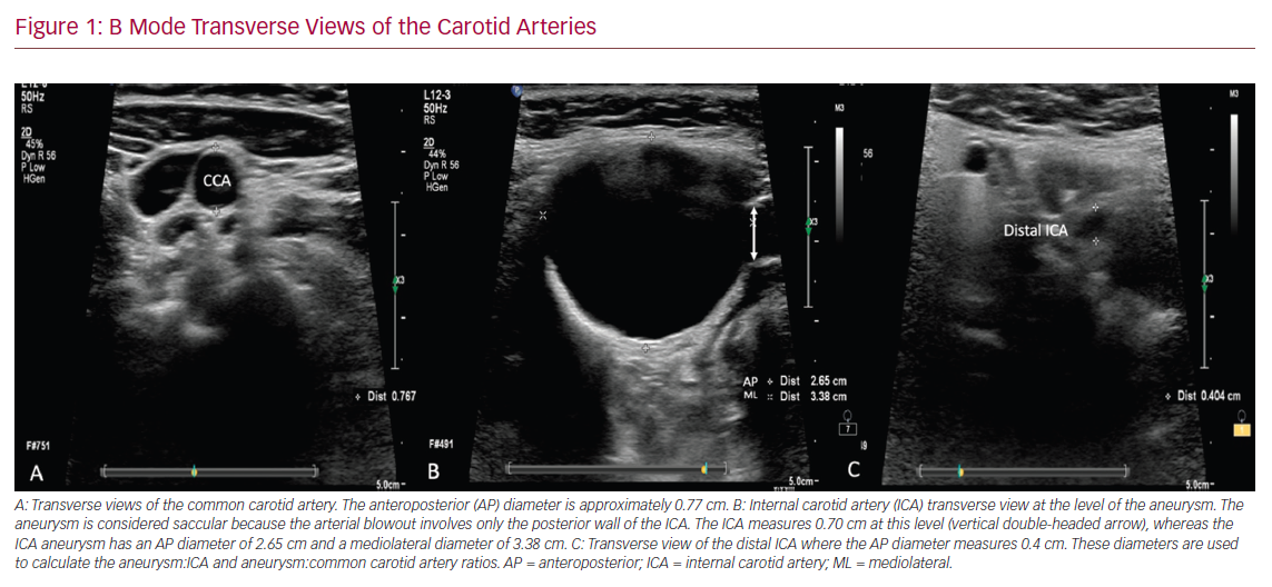 Ultrasound Detection of Extracranial Carotid Artery Aneurysms: A Case Report
