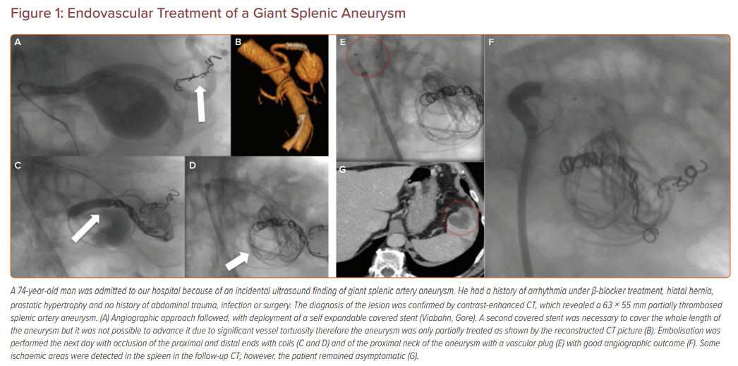 Endovascular Treatment of Giant Visceral Aneurysms: An Overview