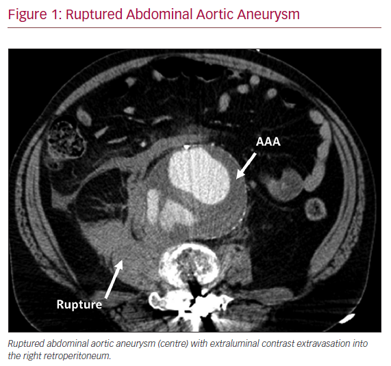 Background and Proposed Design for a Metformin Abdominal Aortic Aneurysm Suppression Trial