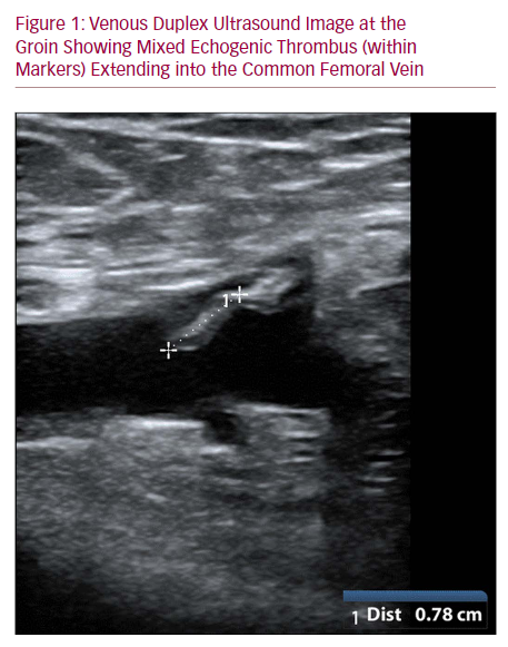 Thrombosis Following Endovenous Glue Ablation