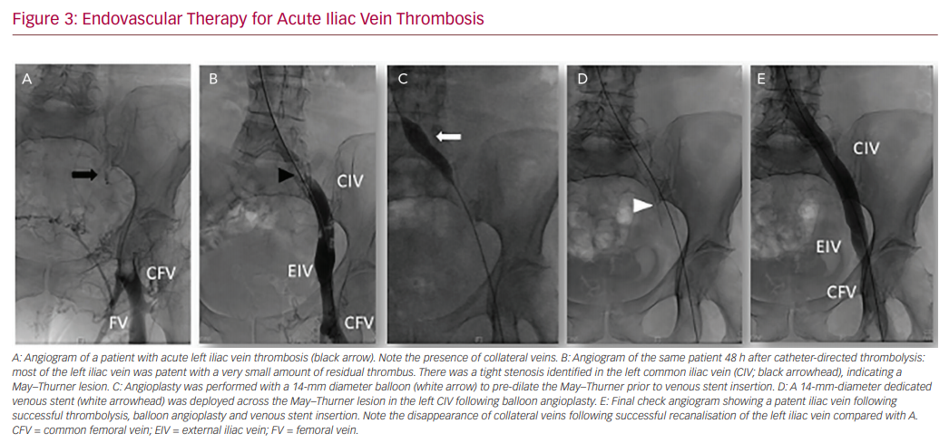 Elastic Compression Stockings foundation therapy for reducing risk of  post-thrombotic syndrome