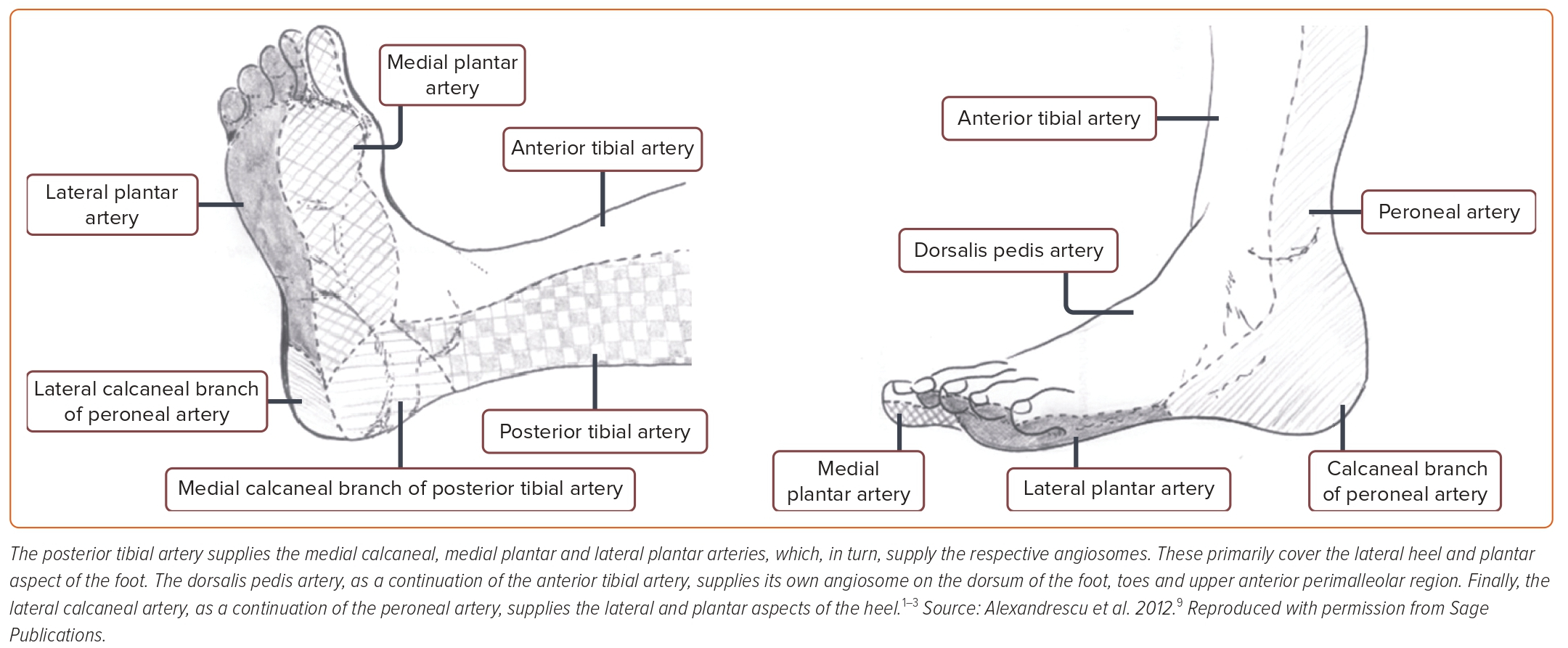 The Role of Targeted Infra-popliteal Endovascular Angioplasty to Treat Diabetic Foot Ulcers Using the Angiosome Model: A Systematic Review